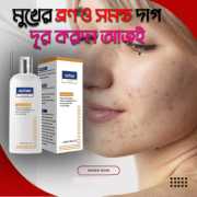 Cleansing Lotion for Acne & Spots & Acanthosis Nigricans (2)